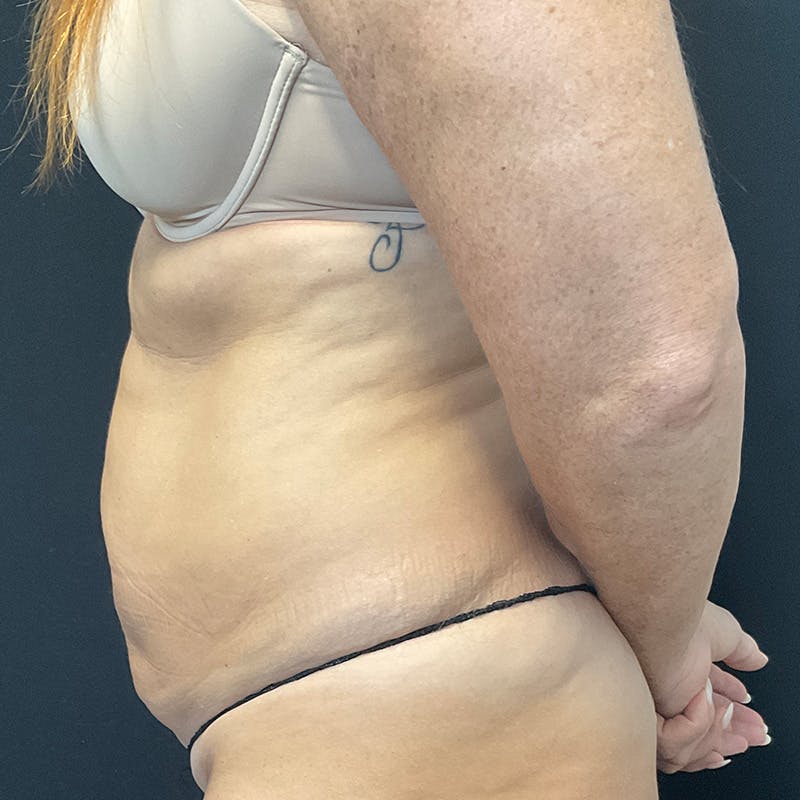 Abdominoplasty (Tummy Tuck) Before & After Gallery - Patient 172845071 - Image 9