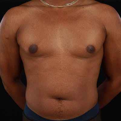 Male Liposuction Before & After Gallery - Patient 172845267 - Image 1