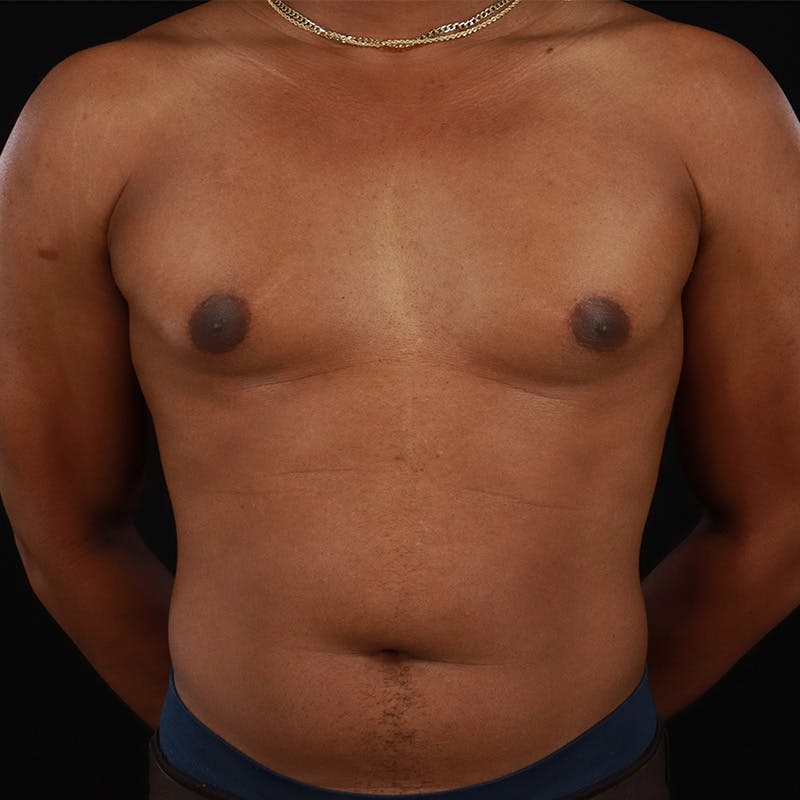 Liposuction Before & After Gallery - Patient 172845267 - Image 1