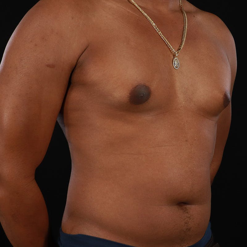 Male Liposuction Before & After Gallery - Patient 172845267 - Image 3