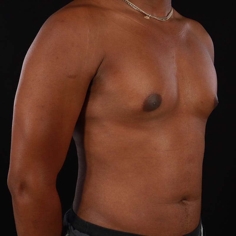 Male Liposuction Before & After Gallery - Patient 172845267 - Image 4