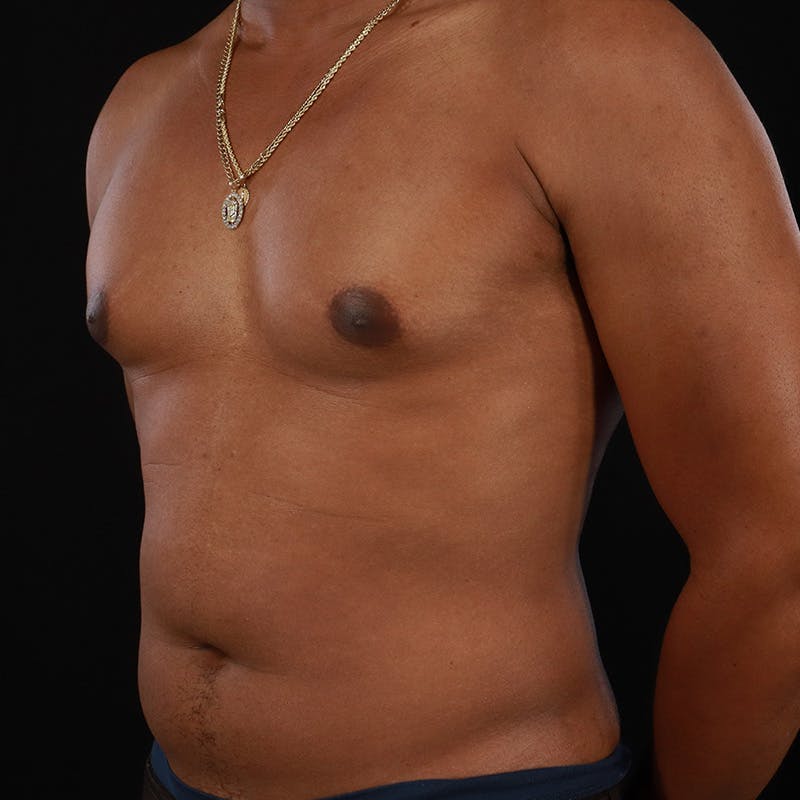 Male Liposuction Before & After Gallery - Patient 172845267 - Image 5