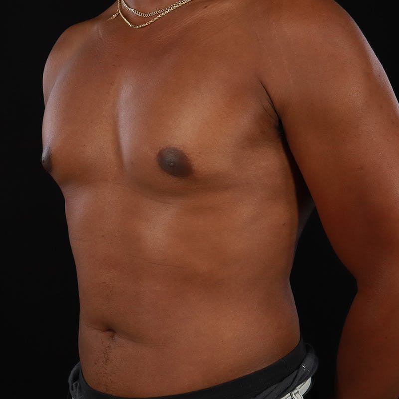 Male Liposuction Before & After Gallery - Patient 172845267 - Image 6