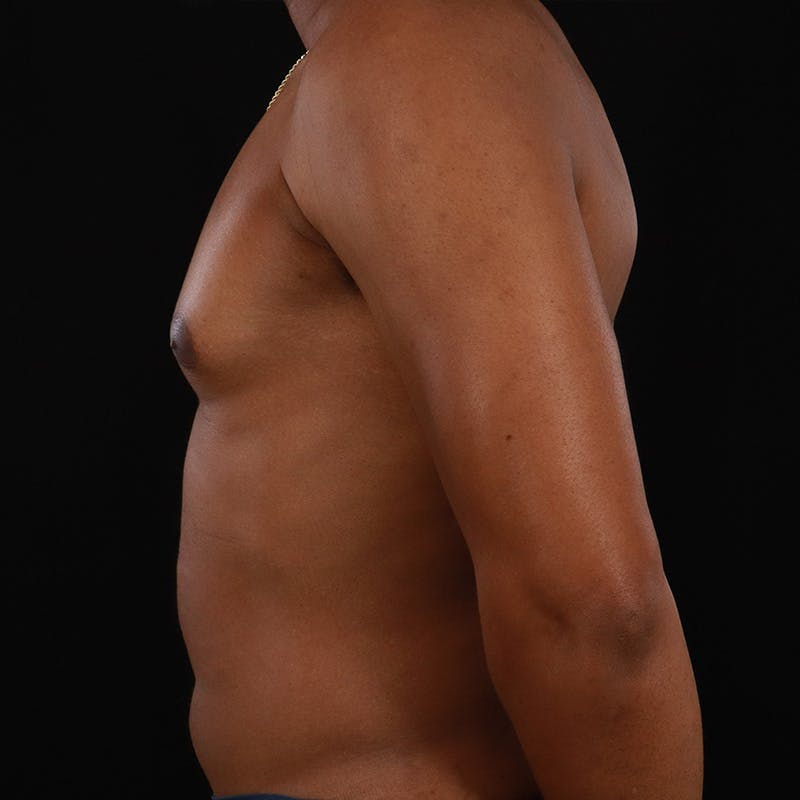 Male Liposuction Before & After Gallery - Patient 172845267 - Image 7