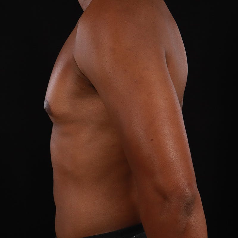Male Liposuction Before & After Gallery - Patient 172845267 - Image 8