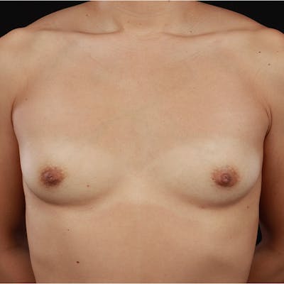 Breast Augmentation Before & After Gallery - Patient 172876579 - Image 1