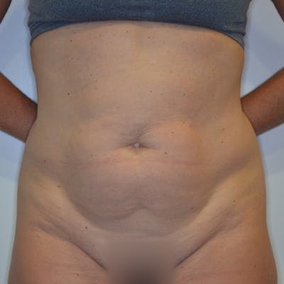 Abdominoplasty (Tummy Tuck) Before & After Gallery - Patient 114721025 - Image 1