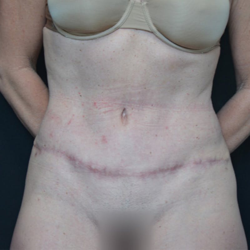 Abdominoplasty (Tummy Tuck) Before & After Gallery - Patient 114721025 - Image 2