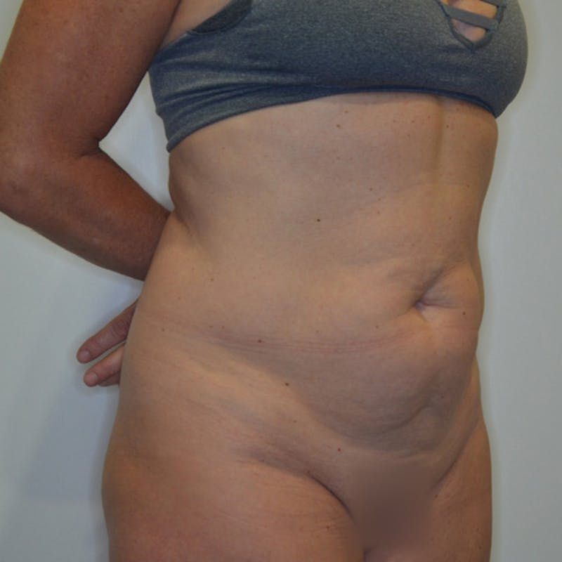 Abdominoplasty (Tummy Tuck) Before & After Gallery - Patient 114721025 - Image 3