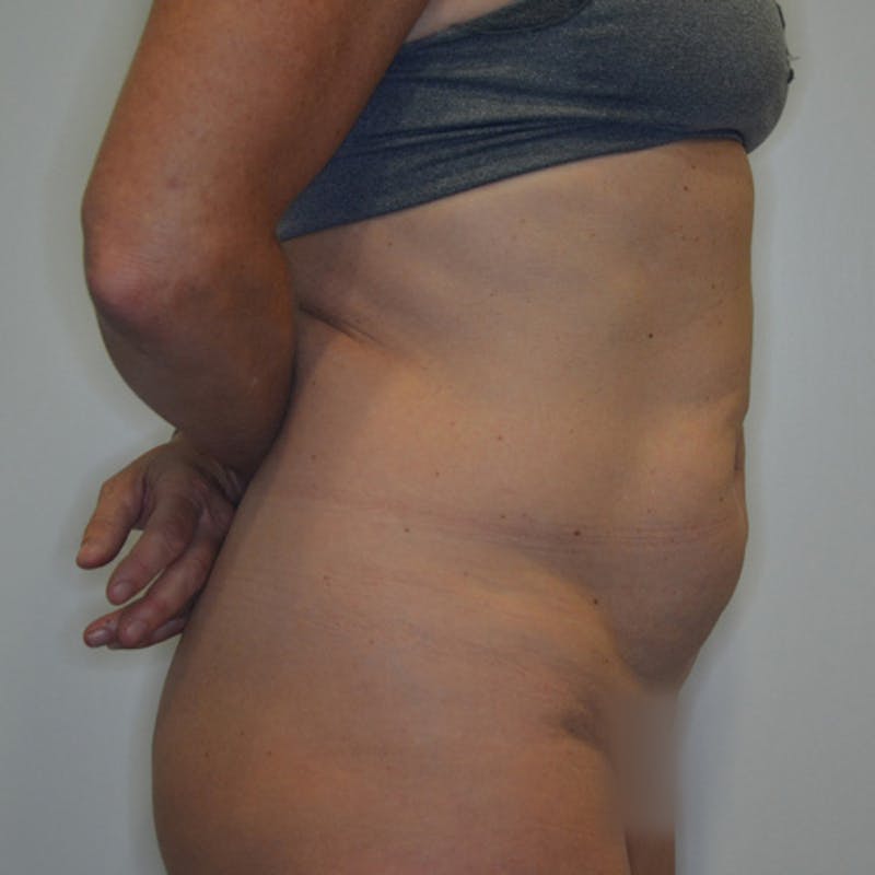 Abdominoplasty (Tummy Tuck) Before & After Gallery - Patient 114721025 - Image 5