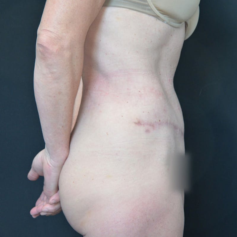 Abdominoplasty (Tummy Tuck) Before & After Gallery - Patient 114721025 - Image 6
