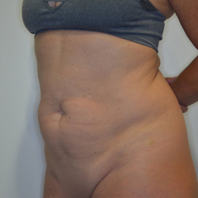 Abdominoplasty (Tummy Tuck) Before & After Gallery - Patient 114721025 - Image 7