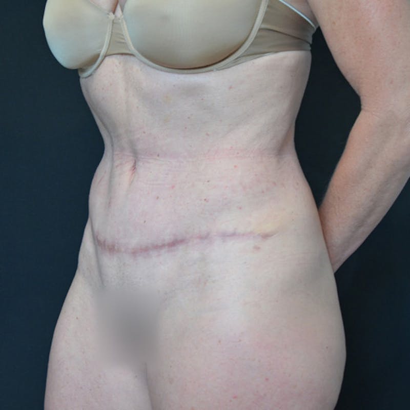 Abdominoplasty (Tummy Tuck) Before & After Gallery - Patient 114721025 - Image 8