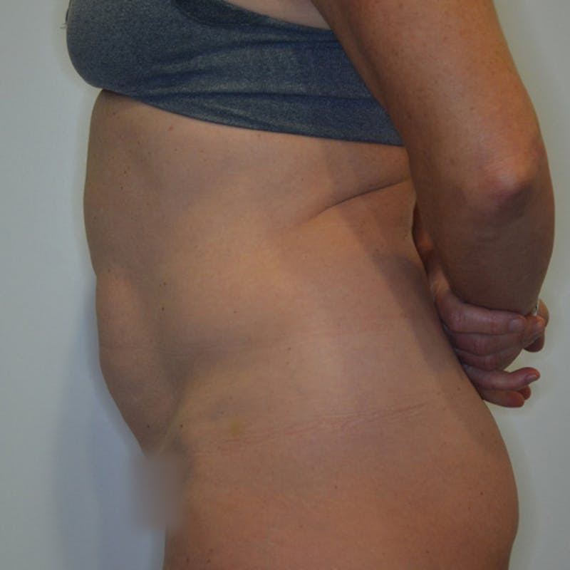 Abdominoplasty (Tummy Tuck) Before & After Gallery - Patient 114721025 - Image 9
