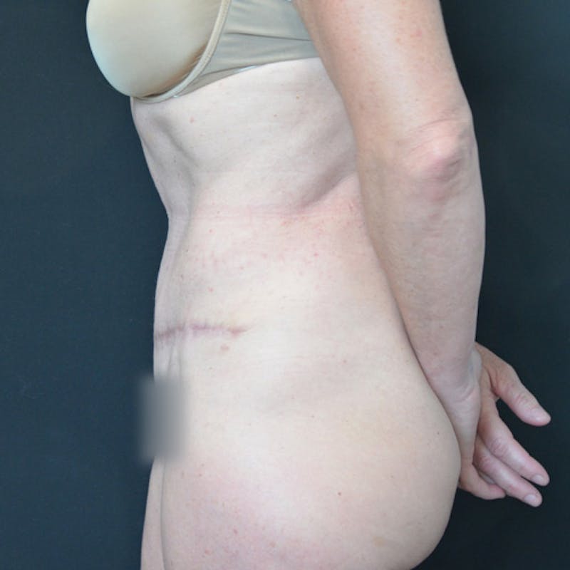Abdominoplasty (Tummy Tuck) Before & After Gallery - Patient 114721025 - Image 10