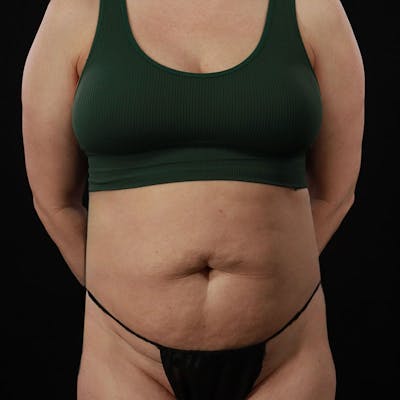 Abdominoplasty (Tummy Tuck) Before & After Gallery - Patient 172845092 - Image 1