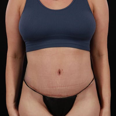 Abdominoplasty (Tummy Tuck) Before & After Gallery - Patient 172845092 - Image 2