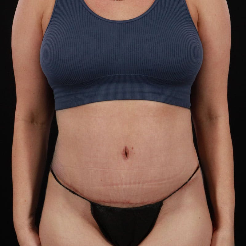 Abdominoplasty (Tummy Tuck) Before & After Gallery - Patient 172845092 - Image 2