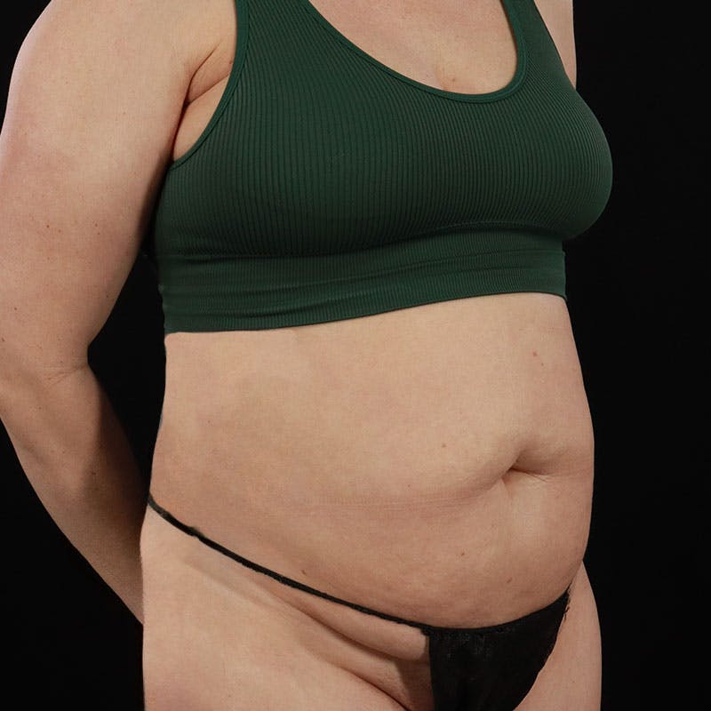 Abdominoplasty (Tummy Tuck) Before & After Gallery - Patient 172845092 - Image 3