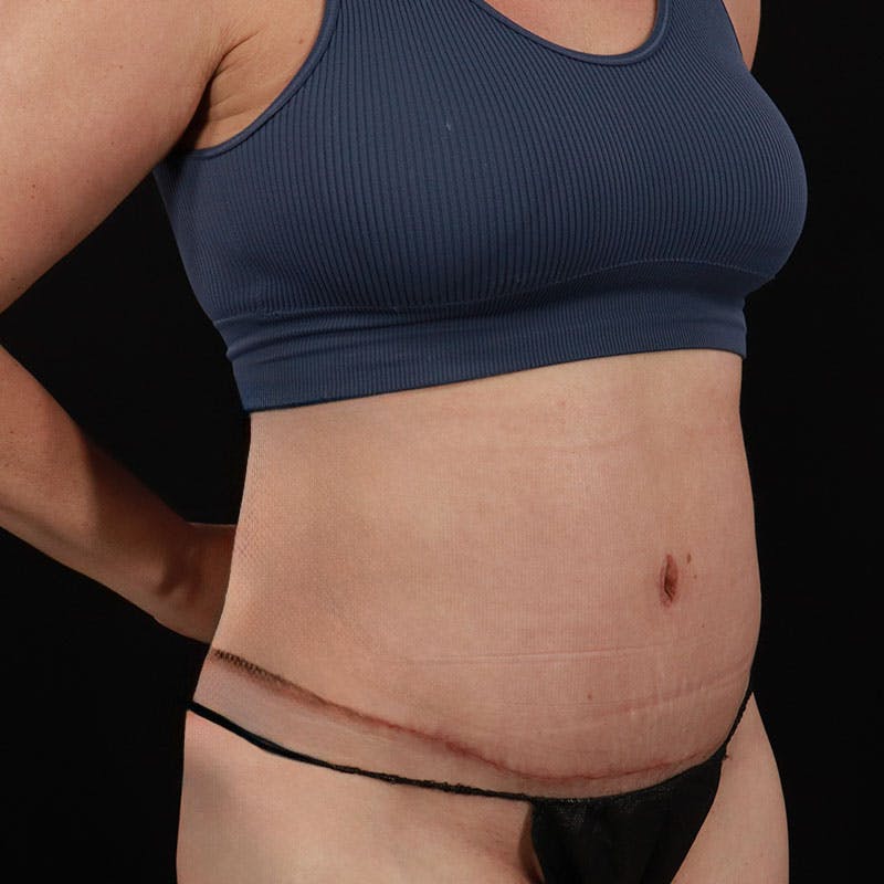 Abdominoplasty (Tummy Tuck) Before & After Gallery - Patient 172845092 - Image 4