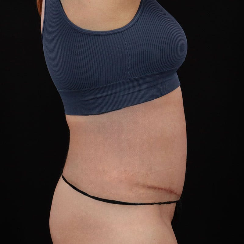 Abdominoplasty (Tummy Tuck) Before & After Gallery - Patient 172845092 - Image 6