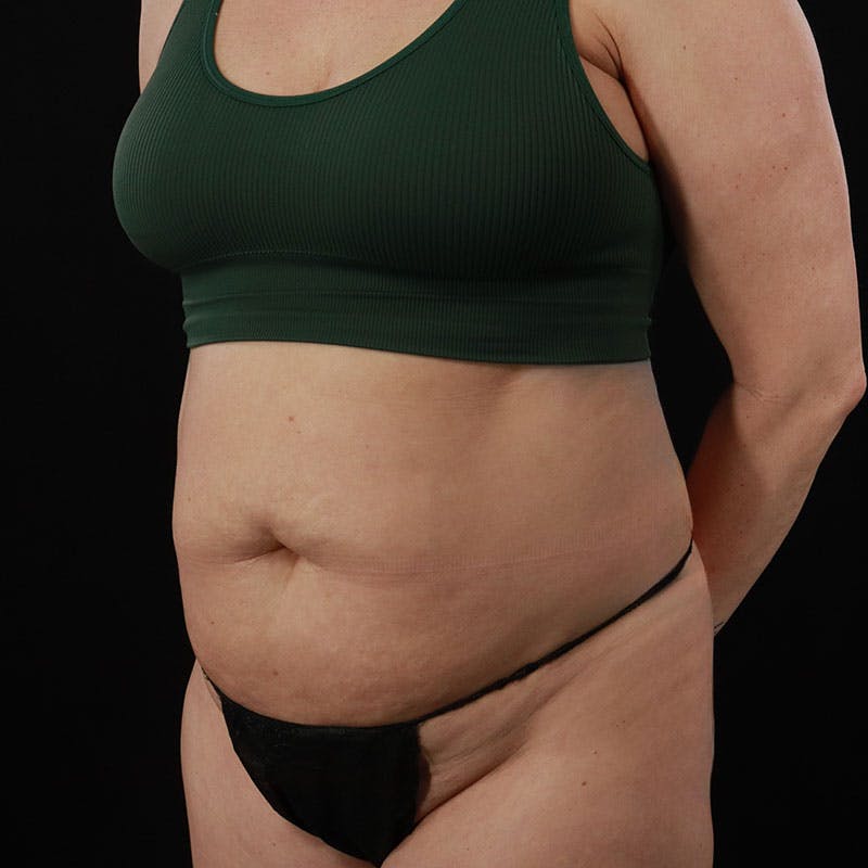 Abdominoplasty (Tummy Tuck) Before & After Gallery - Patient 172845092 - Image 7