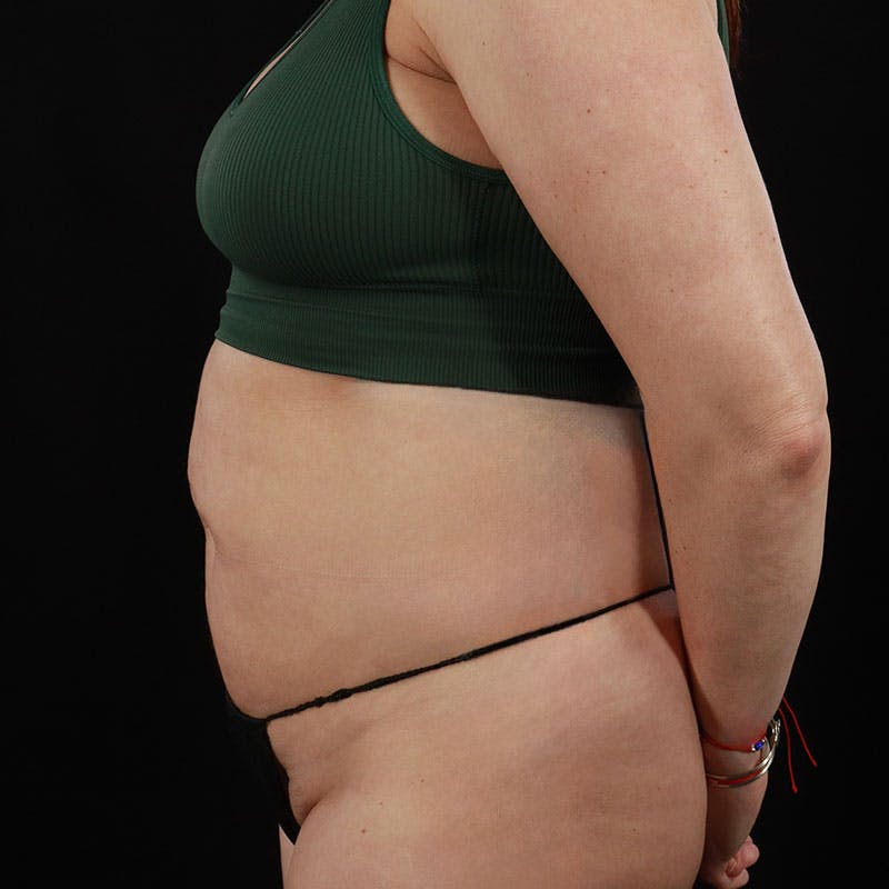Abdominoplasty (Tummy Tuck) Before & After Gallery - Patient 172845092 - Image 9