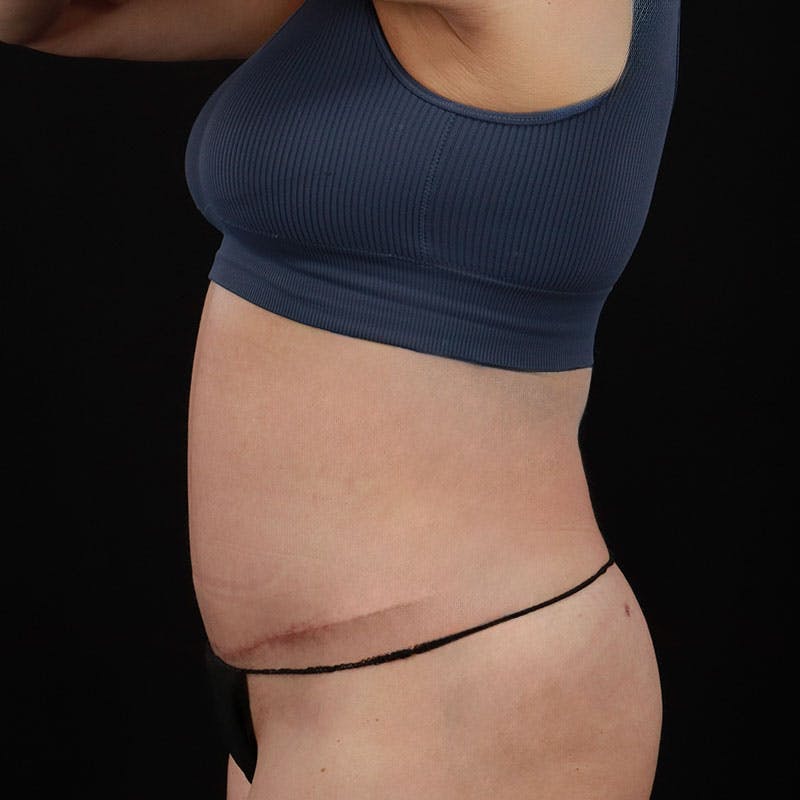 Abdominoplasty (Tummy Tuck) Before & After Gallery - Patient 172845092 - Image 10