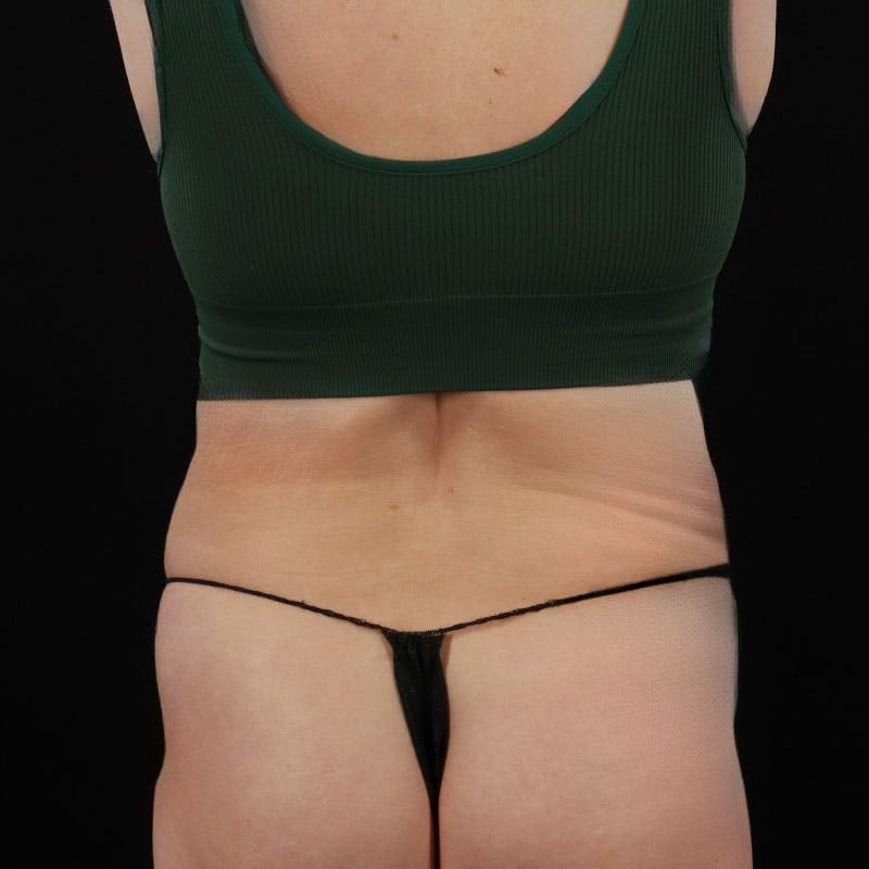 Abdominoplasty (Tummy Tuck) Before & After Gallery - Patient 172845092 - Image 11