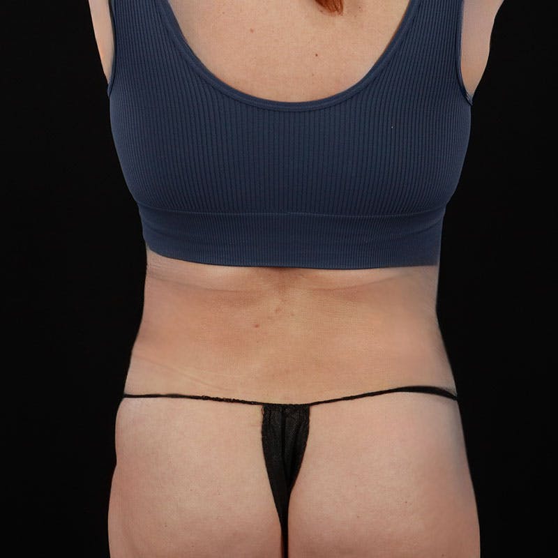 Abdominoplasty (Tummy Tuck) Before & After Gallery - Patient 172845092 - Image 12