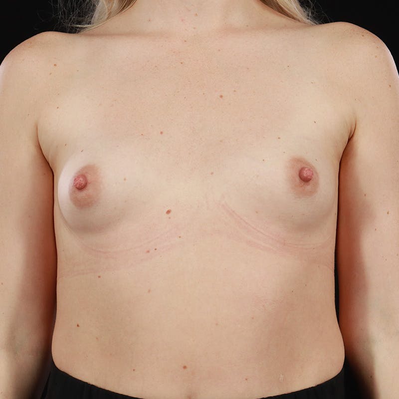 Breast Augmentation Before & After Gallery - Patient 179879182 - Image 1