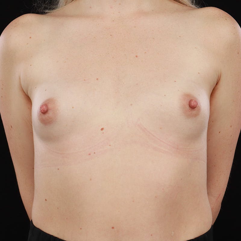 Breast Augmentation Before & After Gallery - Patient 179879182 - Image 5