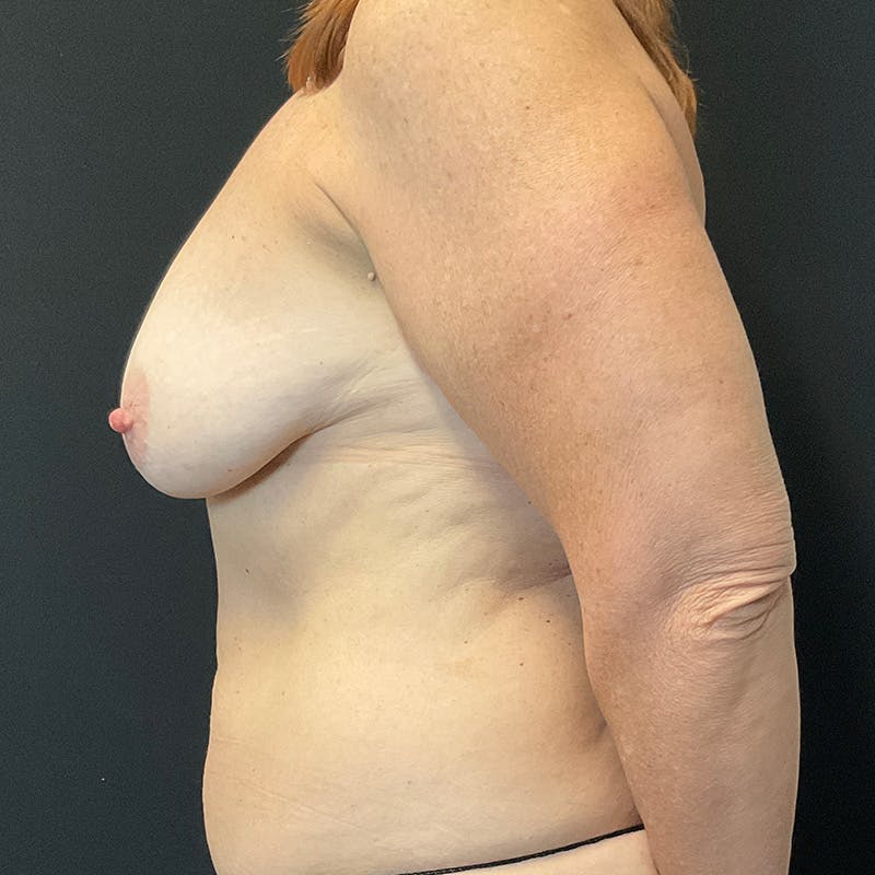 Breast Lift Before & After Gallery - Patient 179897797 - Image 9