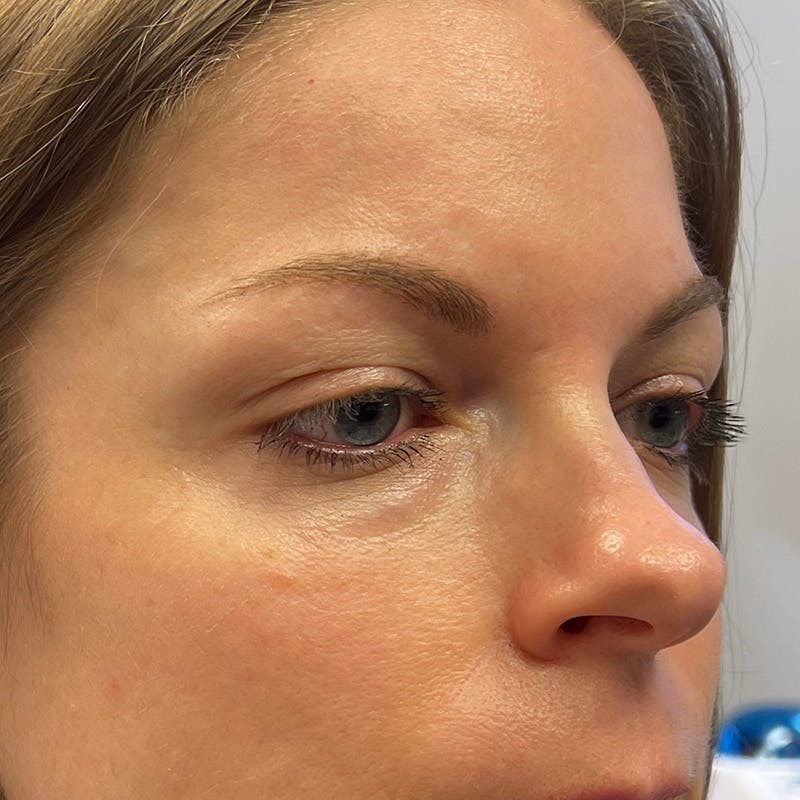 Dermal Fillers Before & After Gallery - Patient 179898097 - Image 3
