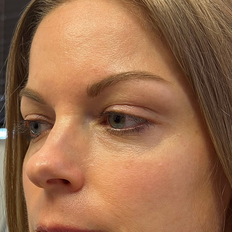 Dermal Fillers Before & After Gallery - Patient 179898097 - Image 5