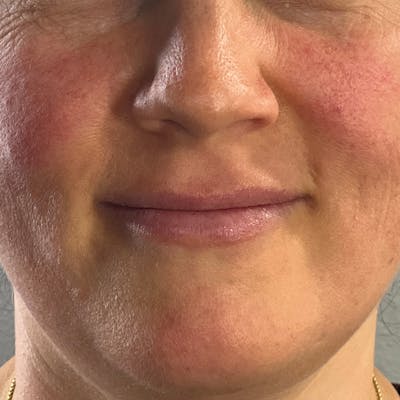 Dermal Fillers Before & After Gallery - Patient 179898098 - Image 1