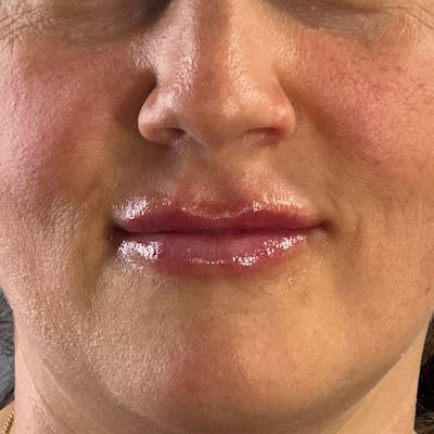 Dermal Fillers Before & After Gallery - Patient 179898098 - Image 2