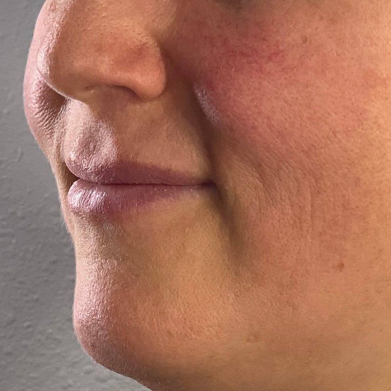 Dermal Fillers Before & After Gallery - Patient 179898098 - Image 5
