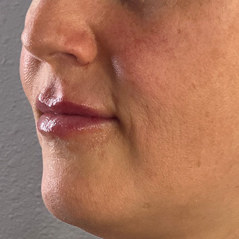 Dermal Fillers Before & After Gallery - Patient 179898098 - Image 6