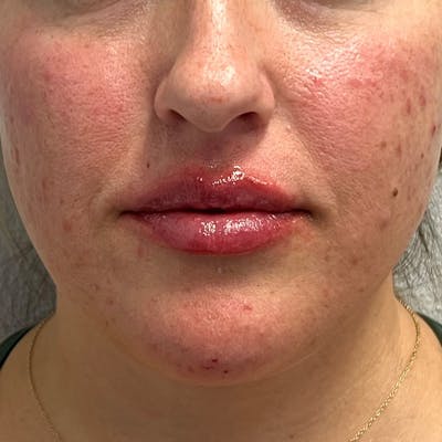 Dermal Fillers Before & After Gallery - Patient 179898119 - Image 2