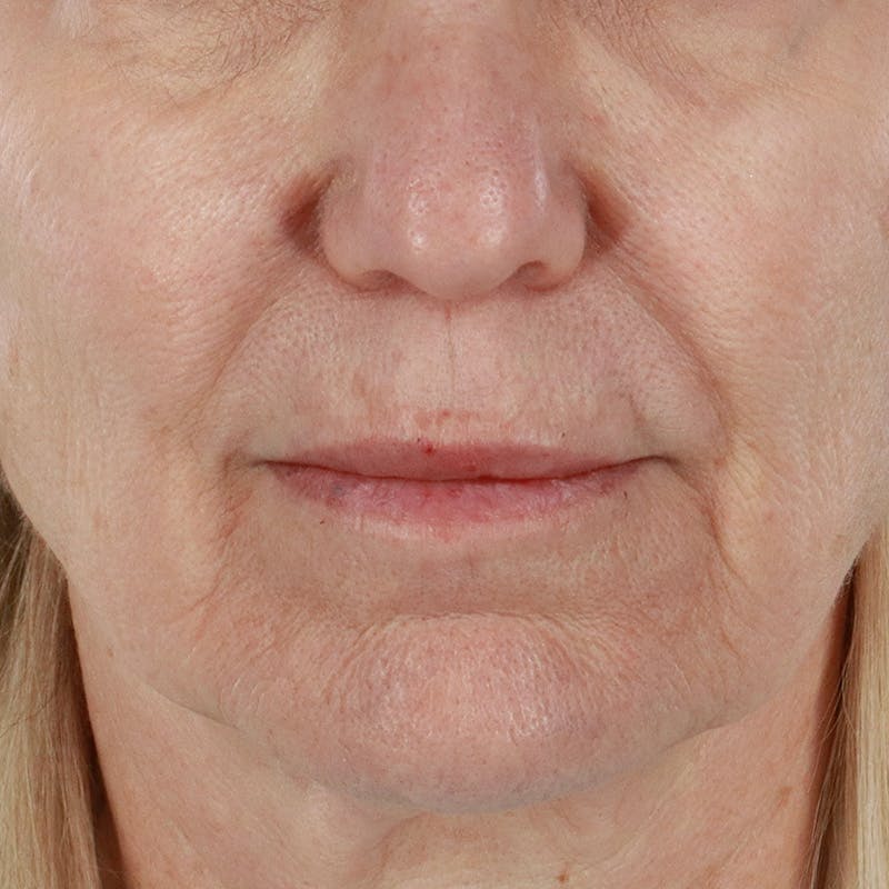 Dermal Fillers Before & After Gallery - Patient 179898133 - Image 1