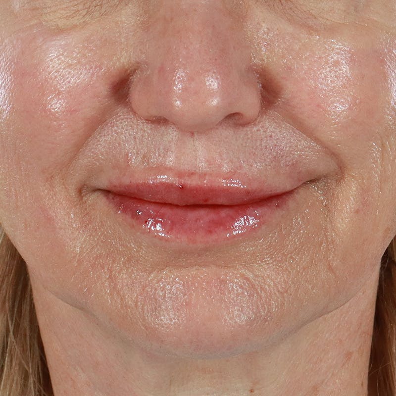 Dermal Fillers Before & After Gallery - Patient 179898133 - Image 2