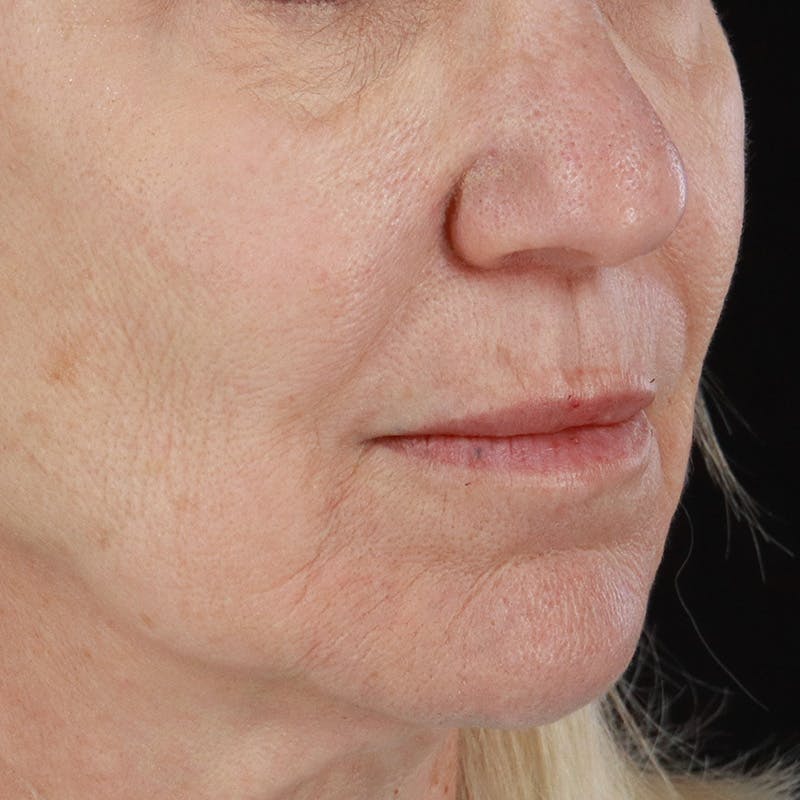 Dermal Fillers Before & After Gallery - Patient 179898133 - Image 3