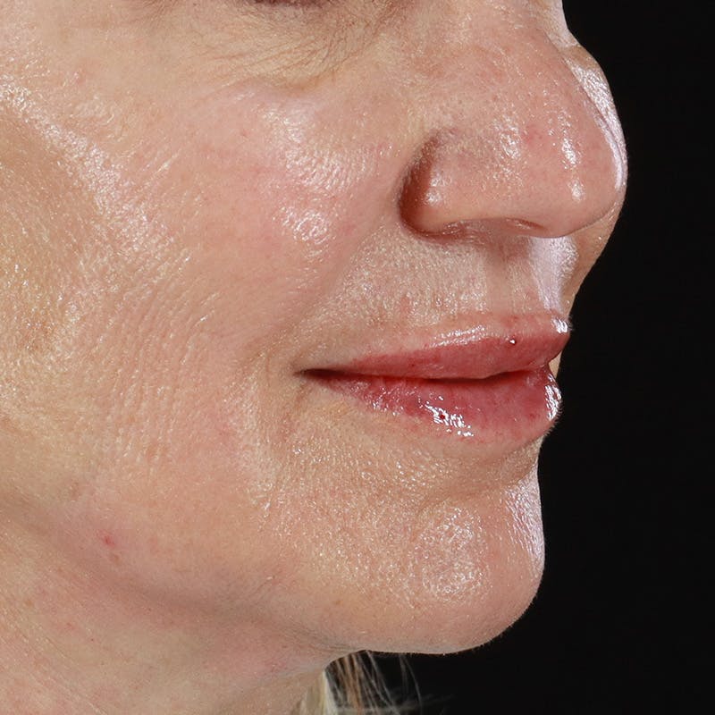 Dermal Fillers Before & After Gallery - Patient 179898133 - Image 4