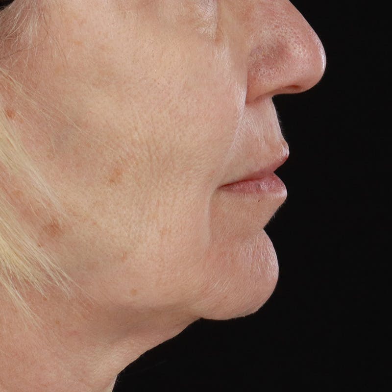 Dermal Fillers Before & After Gallery - Patient 179898133 - Image 5