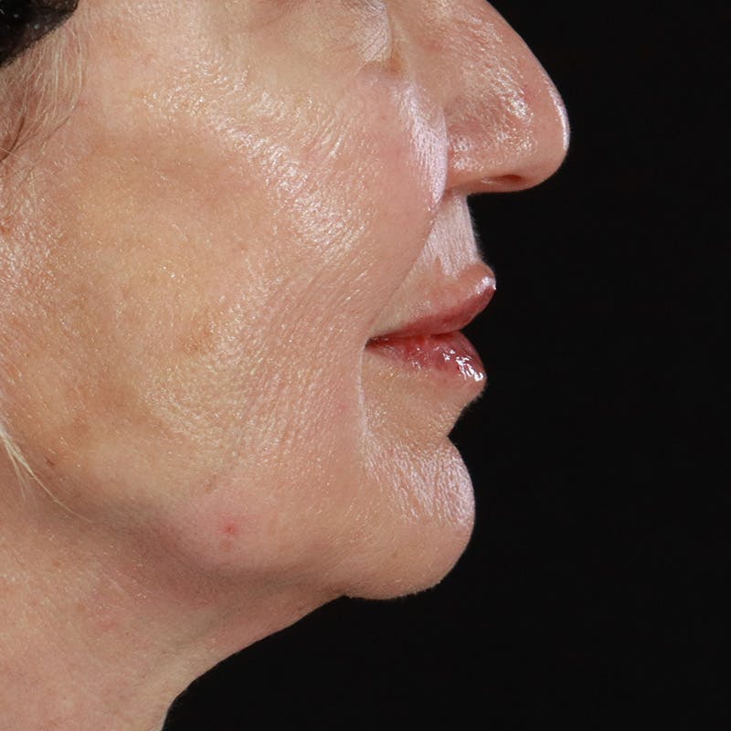 Dermal Fillers Before & After Gallery - Patient 179898133 - Image 6