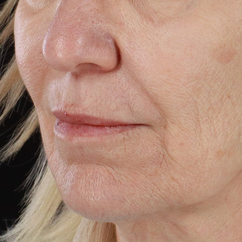 Dermal Fillers Before & After Gallery - Patient 179898133 - Image 7