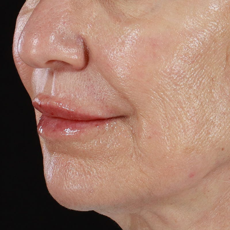 Dermal Fillers Before & After Gallery - Patient 179898133 - Image 8