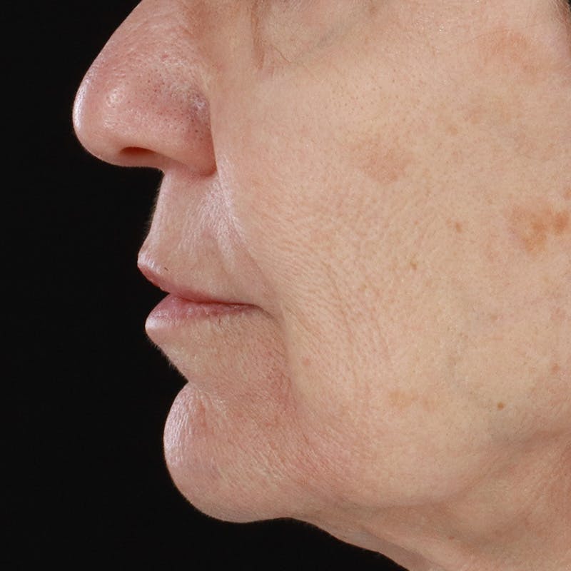 Dermal Fillers Before & After Gallery - Patient 179898133 - Image 9