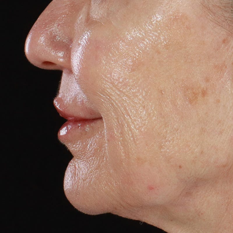 Dermal Fillers Before & After Gallery - Patient 179898133 - Image 10